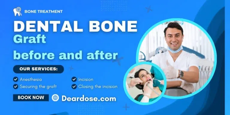 Dental bone graft before and after